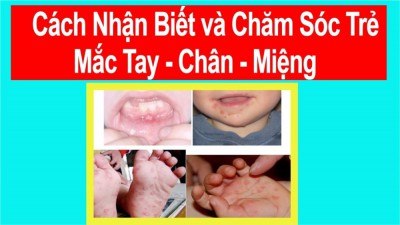 Bài tuyên truyền phòng chống bệnh: Tay - Chân - Miệng