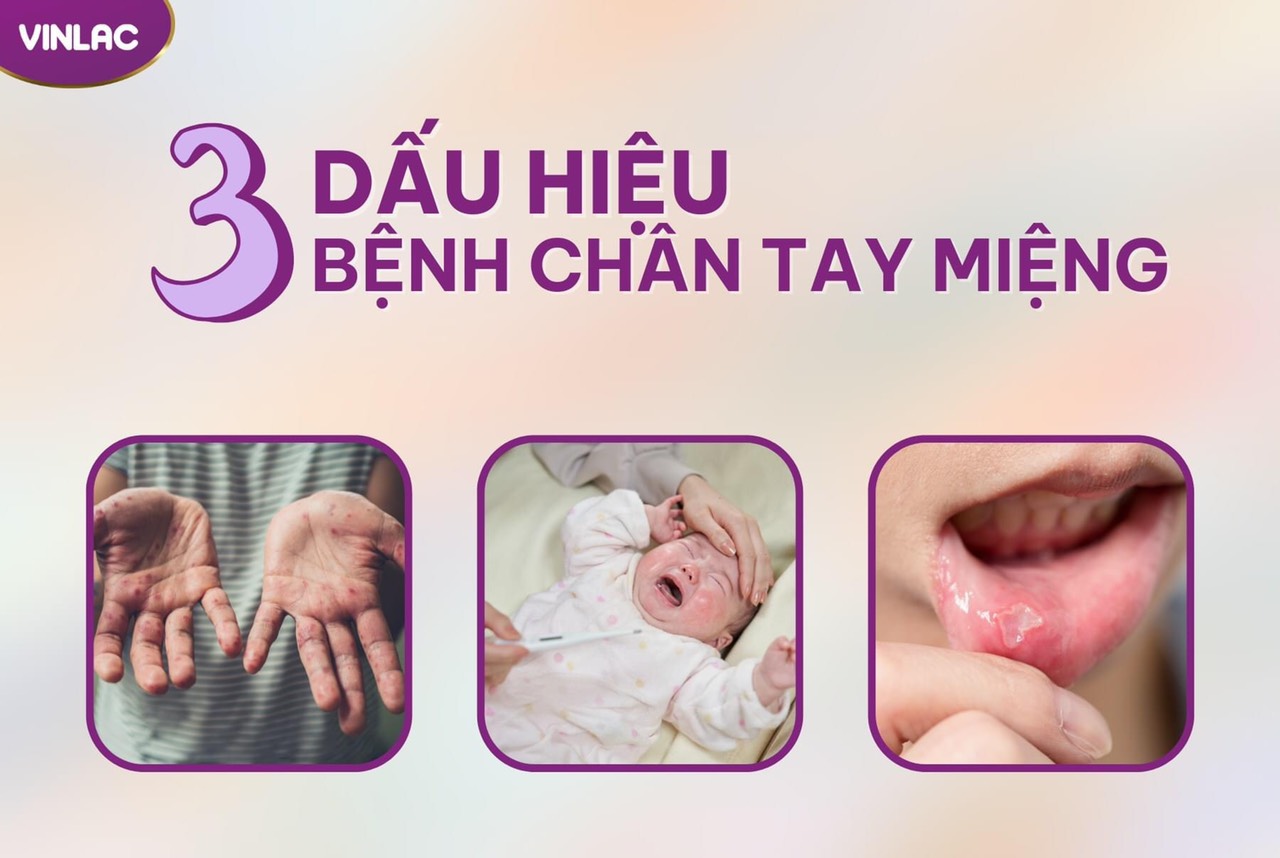 3 Dấu hiệu bệnh tay chân miệng